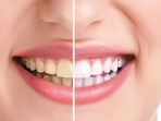 Teeth whitening is a popular cosmetic procedure that can help restore the natural white colour of teeth and enhance the appearance of your smile.(Getty Images/iStockphoto) Teeth whitening is a popular cosmetic procedure that can help restore the natural white colour of teeth and enhance the appearance of your smile.(Getty Images/iStockphoto)