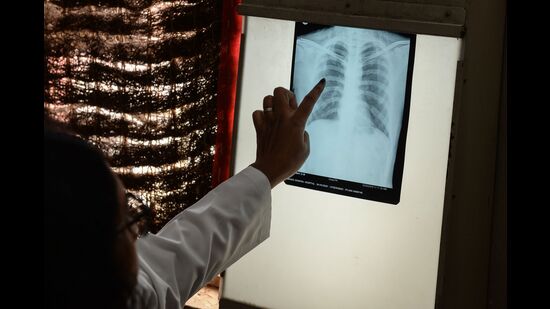 Government of India (GoI) is working towards eradicating TB by 2025 with newer vaccines and shorter courses of treatment, and a rise in EPTB cases will only jeopardise these efforts. (REPRESENTATIVE IMAGE) Government of India (GoI) is working towards eradicating TB by 2025 with newer vaccines and shorter courses of treatment, and a rise in EPTB cases will only jeopardise these efforts. (REPRESENTATIVE IMAGE)