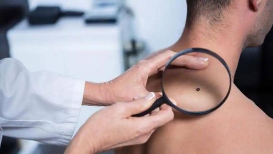 Memory killer cells can improve melanoma patients' chances of survival: Study(Shutterstock)