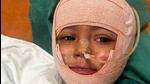 Two-year-old with third-degree burns discharged after 3 months Two-year-old with third-degree burns discharged after 3 months