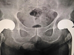 How little things can reduce hip fractures: Study(Shutterstock) How little things can reduce hip fractures: Study(Shutterstock)