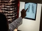 Awareness and early treatment are even more vital given that women and girls make up nearly one million of the estimated 2.8 million TB cases in India each year (HT PHOTO) Awareness and early treatment are even more vital given that women and girls make up nearly one million of the estimated 2.8 million TB cases in India each year (HT PHOTO)
