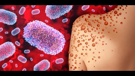 There are 22 labs for Mpox in India and there are 13 buffer labs, with PGIMER, Chandigarh, being one of them. (Shutterstock) There are 22 labs for Mpox in India and there are 13 buffer labs, with PGIMER, Chandigarh, being one of them. (Shutterstock)