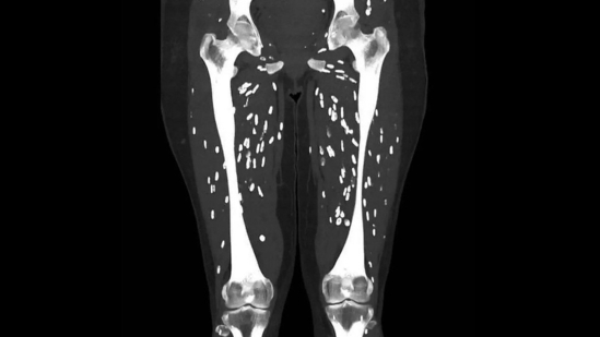 Dr Sam Ghali shared the CT scan image of a patient with cysticercosis. (X/@EM_RESUS) Dr Sam Ghali shared the CT scan image of a patient with cysticercosis. (X/@EM_RESUS)