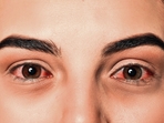 There is no treatment or vaccine for the Margburg virus aka the bleeding eye virus (adobe stock) There is no treatment or vaccine for the Margburg virus aka the bleeding eye virus (adobe stock)