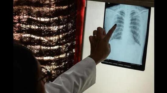 Data showed that there are 32.65 lakh vulnerable persons in 18 districts of Punjab, but only 5.75 lakh have been screened for TB as of January 6. (HT Photo)