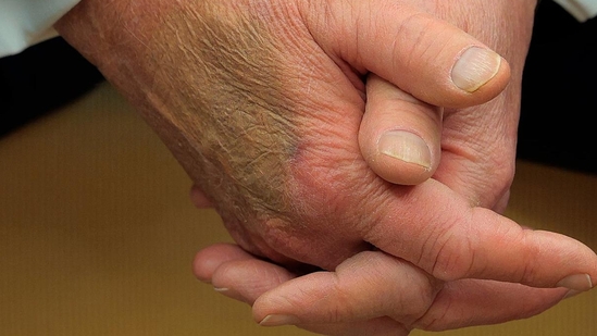 When Trump and Macron sat in front of reporters and gave each other a long, awkward handshake, the bruise - which was disguised with makeup - was noticed. X users offered their own hypotheses on the potential source of the bruise after a close-up of Trump's hand showed discoloration.(AP/X)