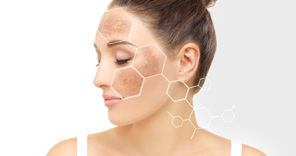 Hyperpigmentation is usually in patches.(Shutterstock) Hyperpigmentation is usually in patches.(Shutterstock)