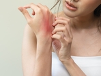 Emma Simms struggled with itchy skin for months before doctors diagnosed her with cancer.(Representational) Emma Simms struggled with itchy skin for months before doctors diagnosed her with cancer.(Representational)