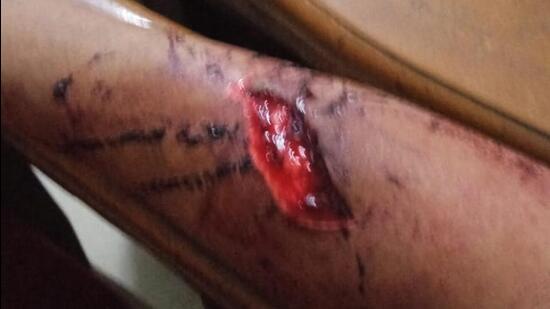 The victim suffered a deep cut on her right arm The victim suffered a deep cut on her right arm